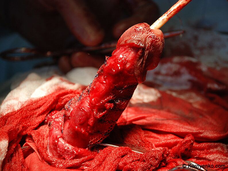 Installazione di una matrice di collagene per l'ingrandimento del pene