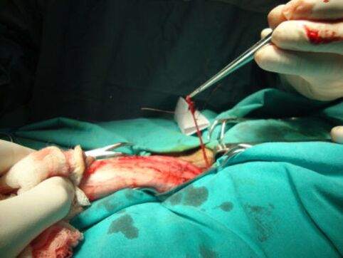 Intervento chirurgico per l'ingrandimento del pene